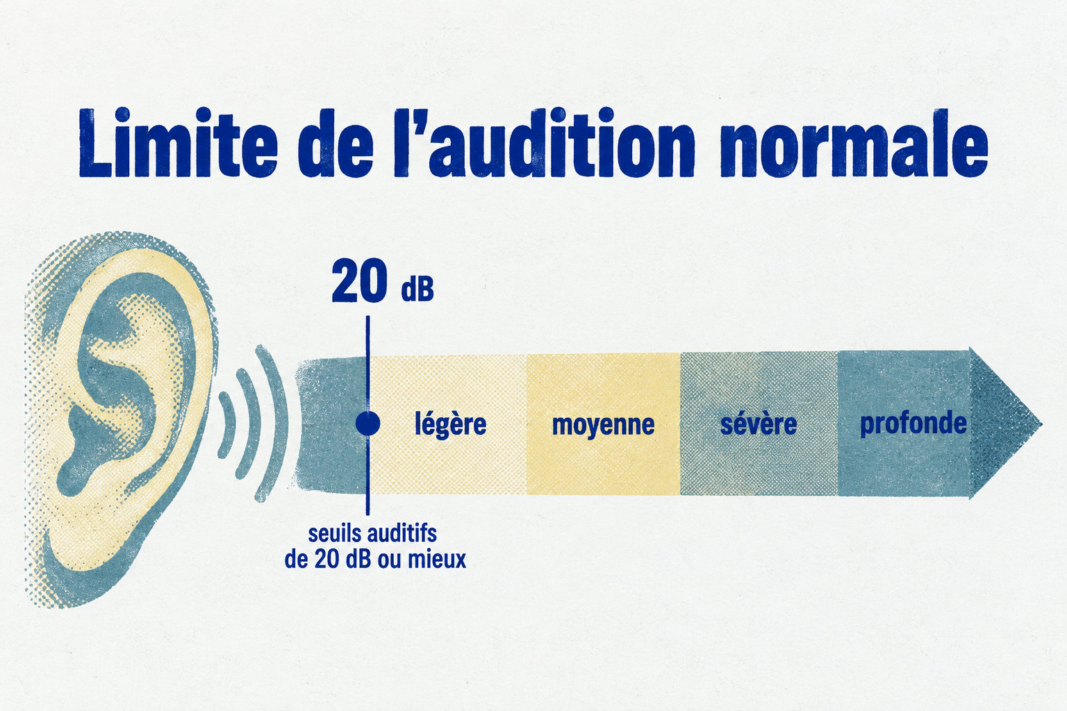 Le seuil de référence de l’audition normale est marqué à 20 dB, avant les zones de perte légère, moyenne, sévère et profonde.